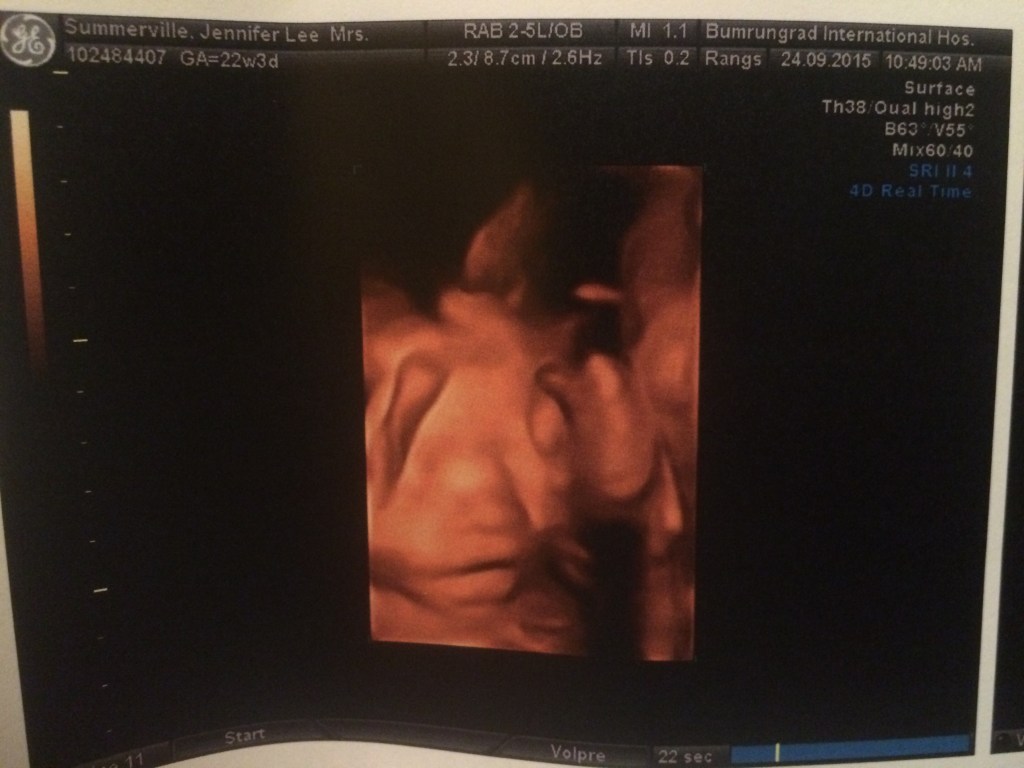 Protected: The Amazing Anna&nbsp;Lynn.